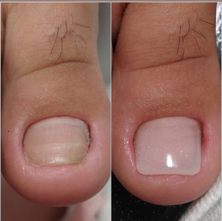 Toe Nail Repair